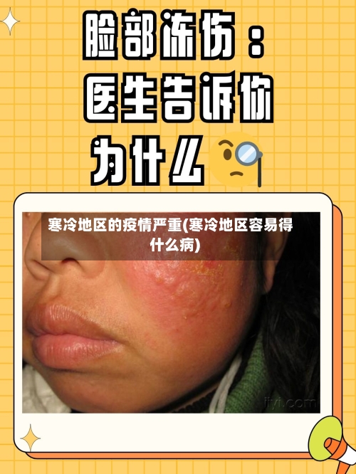 寒冷地区的疫情严重(寒冷地区容易得什么病)-第2张图片