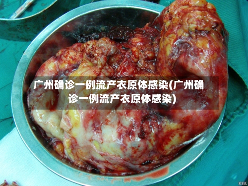 广州确诊一例流产衣原体感染(广州确诊一例流产衣原体感染)