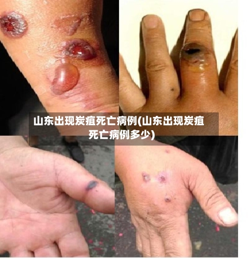 山东出现炭疽死亡病例(山东出现炭疽死亡病例多少)