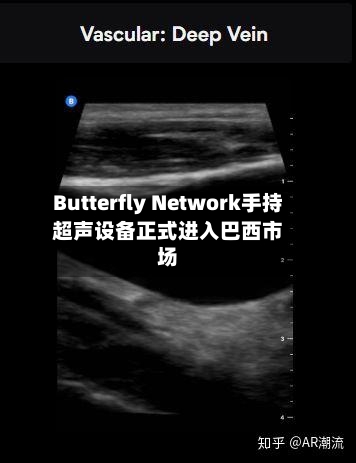 Butterfly Network手持超声设备正式进入巴西市场-第3张图片